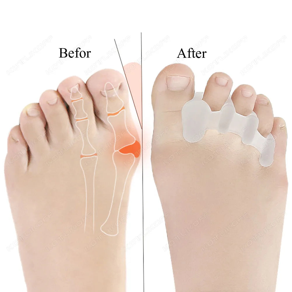Soft Gel Bunion Toe Separator