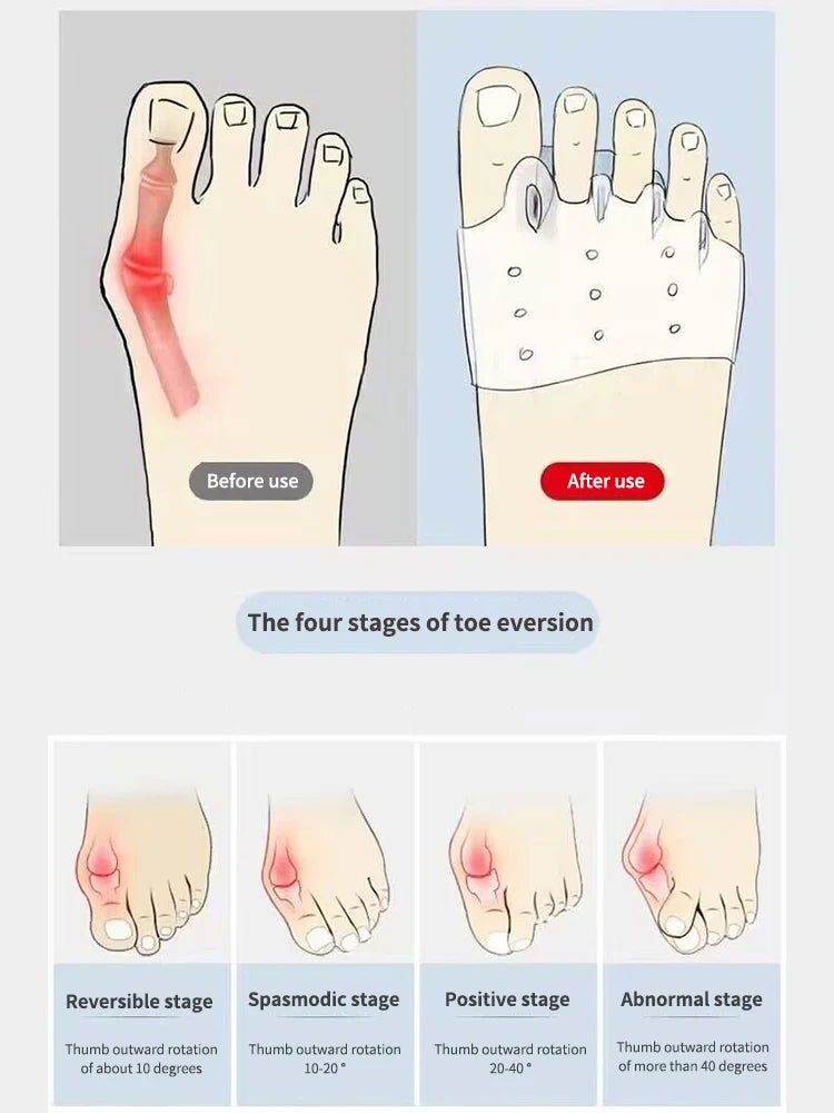 Toe Spacer & Forefoot Pad Protector