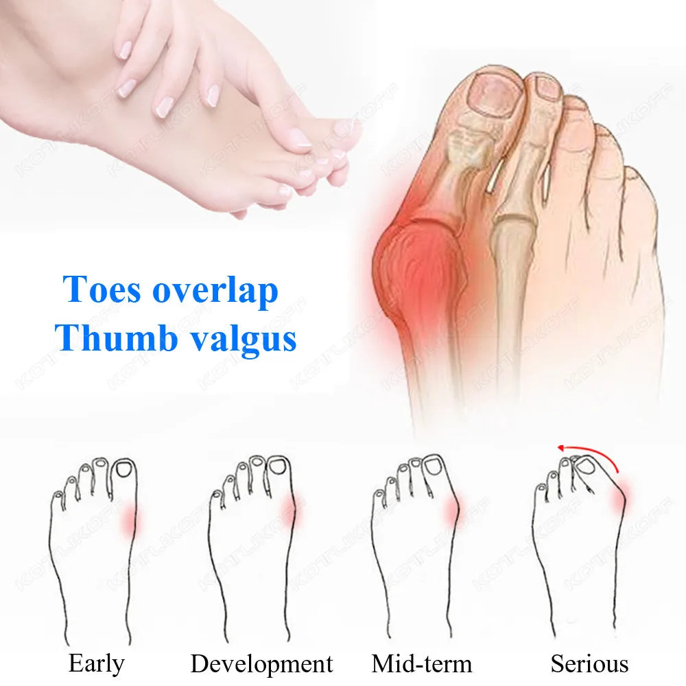 Soft Gel Bunion Toe Separator